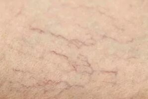 Estrellas vasculares