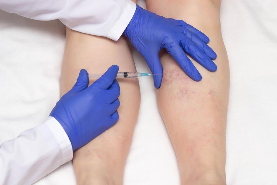 La escleroterapia es un método para tratar las venas varicosas.
