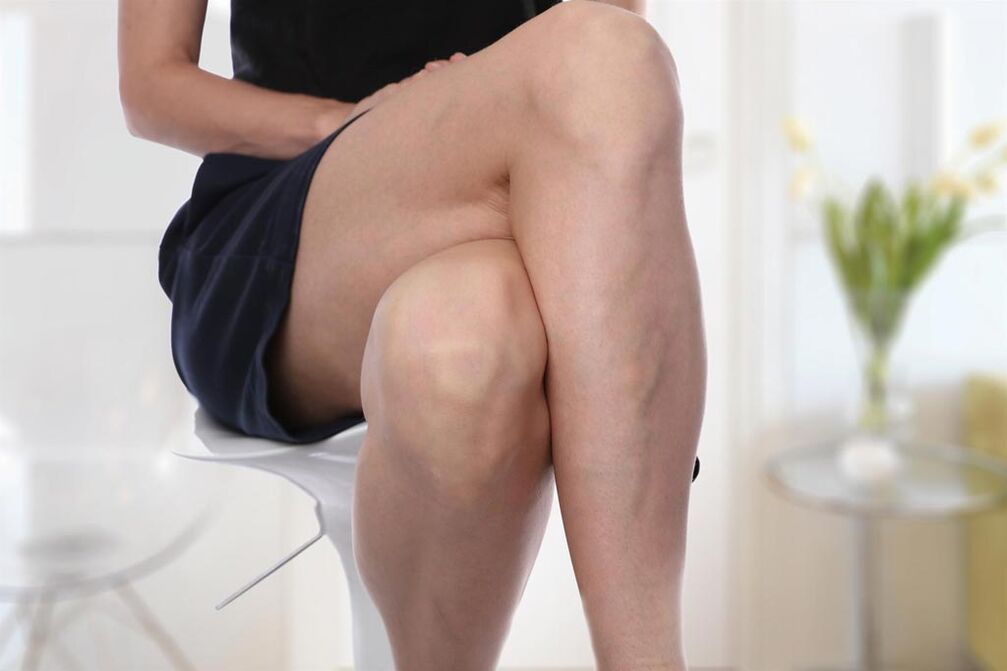 Venas varicosas en una mujer.