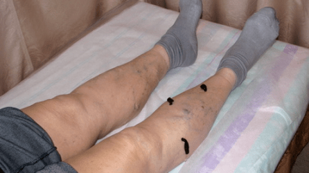 tratamiento de venas varicosas con sanguijuelas