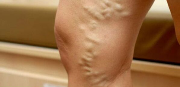venas varicosas en las piernas de las mujeres