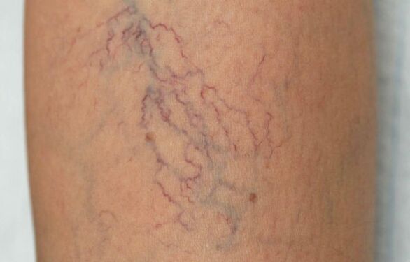 venas varicosas en las piernas en mujeres