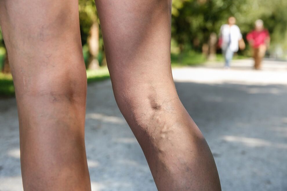 venas varicosas en las piernas