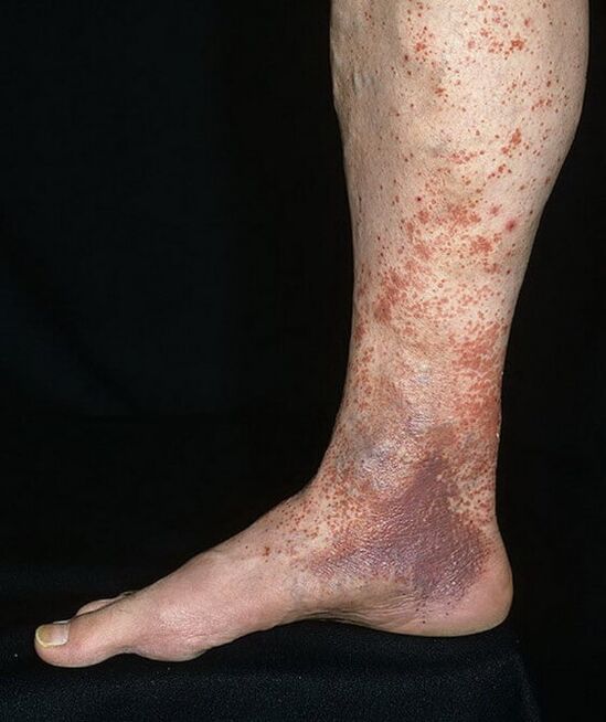 Dermatitis varicosa