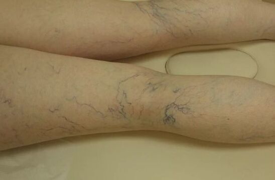 Estrellas varicosas en las piernas
