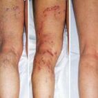 Venas varicosas de las piernas.