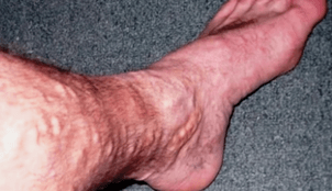 causas de varices en las piernas en los hombres