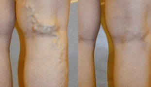 signos y síntomas de varices en las piernas en los hombres