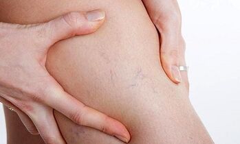 Razones para el desarrollo de venas varicosas en las piernas.