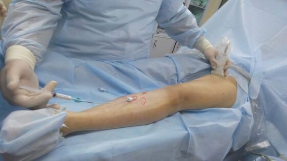 Cirugía de varices en las piernas. 