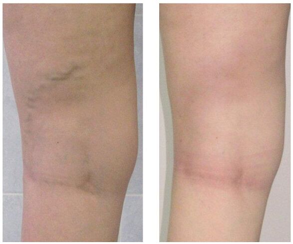 vena en la pierna antes y después del tratamiento de las varices