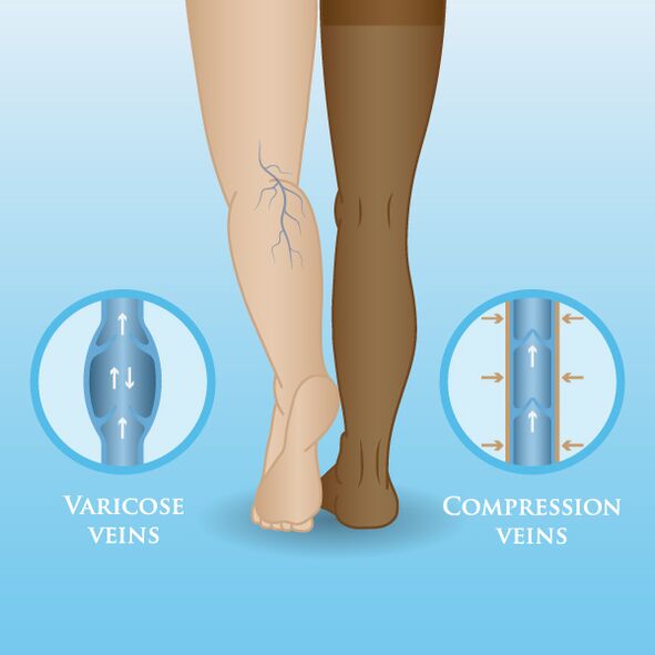 Efectos de las prendas de compresión sobre las varices de las piernas