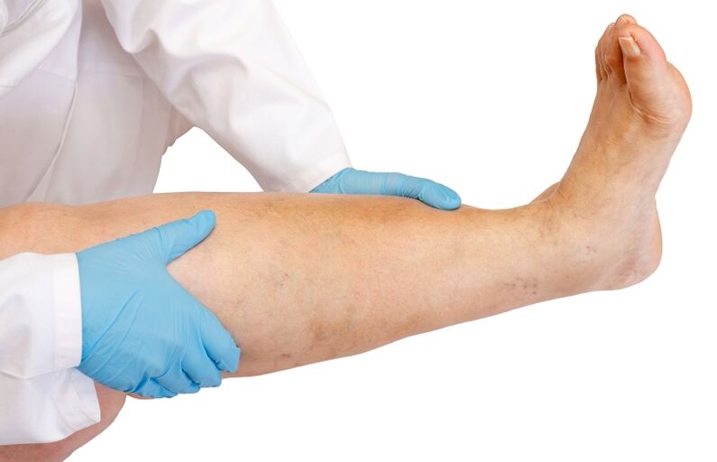 el médico examina la pierna con venas varicosas