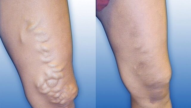 Piernas antes y después del tratamiento de varices graves