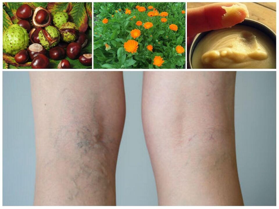 Varices en las piernas y remedios caseros para su prevención. 