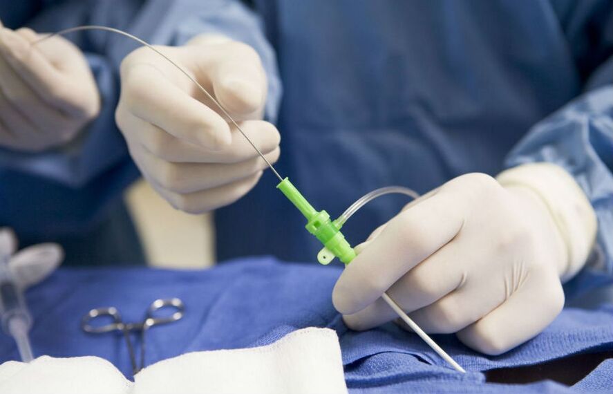 tratamiento quirúrgico de varices