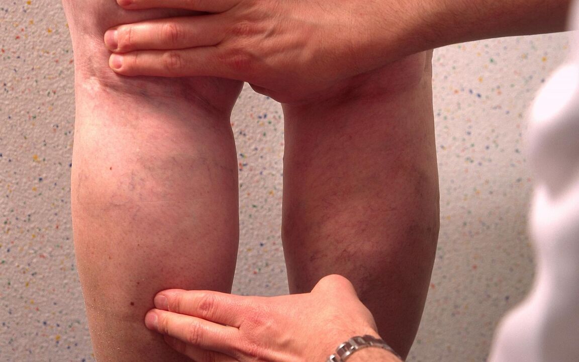el médico examina las piernas con varices
