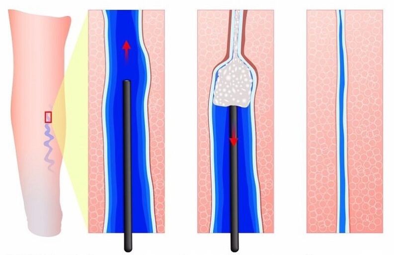 escleroterapia para varices en las piernas en hombres