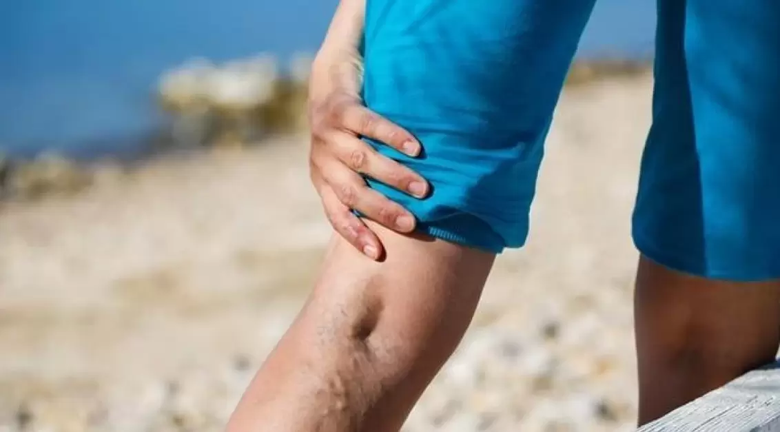 Las venas azules abultadas en las piernas son un signo de venas varicosas. 